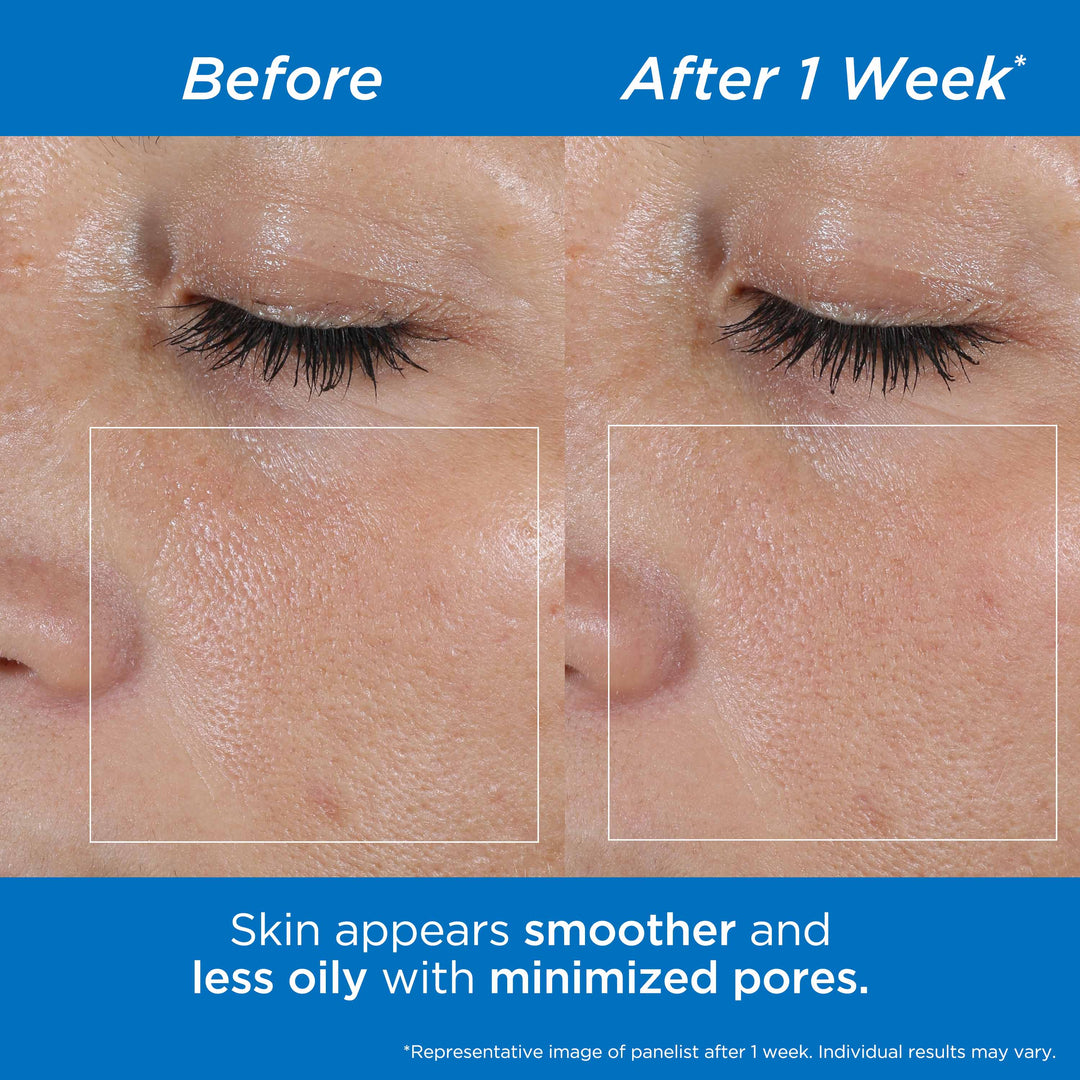 Before and After. Skin appears smoother and less oily with minimized pores. *Representative image of product after 1 week. Individual results may vary